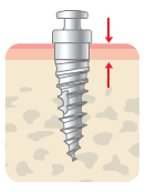 Buccal Micro Implants