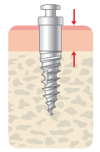 Palatal Micro Implants